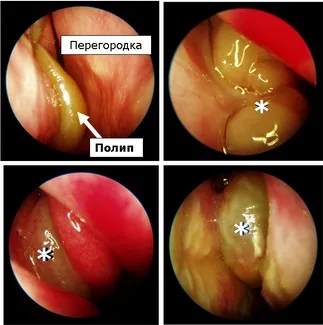 Что такое полипозный риносинусит