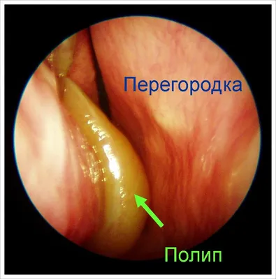 Полипоз носа: лечение полипов в носу в Одессе | Клиника доктора Запорожченко