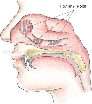 Полипозный риносинусит (полипы полости носа) - диагностика и лечение в  Москве. Консультация врача.