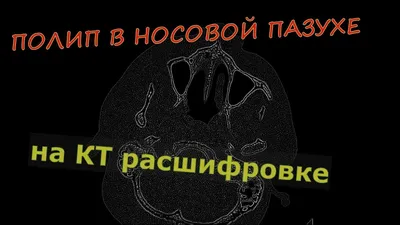 Эндоскопическая полипотомия носа / полипоэтмоидотомия/ удаление полипов в  носу - «Эндоскопическая полипотомия носа. Операция по удалению полипов в  носу. От чиха по утрам до полипов всего один шаг. Мой опыт.» | отзывы