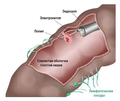 Что такое полипозный риносинусит