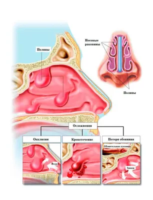 Полипы полости носа: причины появления, симптомы, медицинская помощь,  лечение в Москве