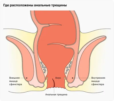 Полипы кишечника при геморрое - Проктология, заболевания