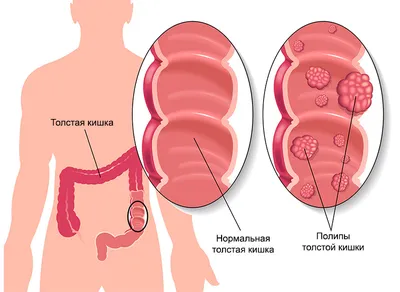 Полипы в заднем проходе фото