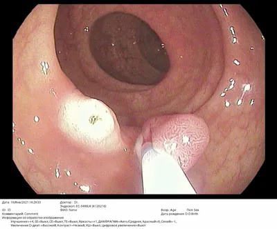 Полипы кишечника при геморрое - Проктология, заболевания