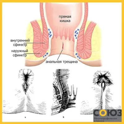 Что такое полипы прямой кишки, их диагностика и лечение