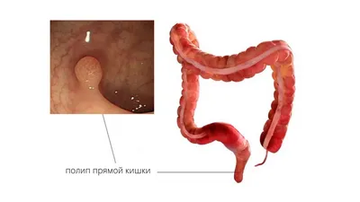 Полипы в кишечнике: причины, виды, симптомы, диагностика и лечение полипов  кишечника в Москве - сеть клиник «Ниармедик»