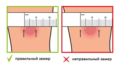 Проба Манту: для чего делают, размеры, оценка и интерпретация результата у  детей - Азбука здоровья