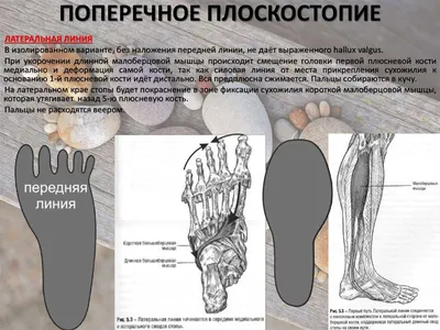 Поперечное плоскостопие. Мозоли, натоптыши. Слабость длинной и короткой  малоберцовых мышц | Денис Иванов | Дзен