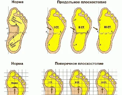 Виды плоскостопия | ВКонтакте