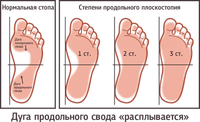 Виды и степени плоскостопия: лечение и профилактика
