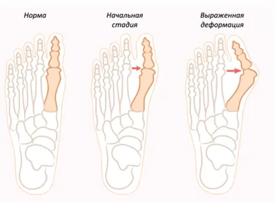 У РЕБЁНКА ПЛОСКОСТОПИЕ: ЧТО ДЕЛАТЬ? - купить недорого / Самара, Тольятти,  Ульяновск, Сызрань