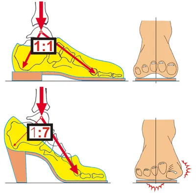Поперечное плоскостопие. Как предотвратить?