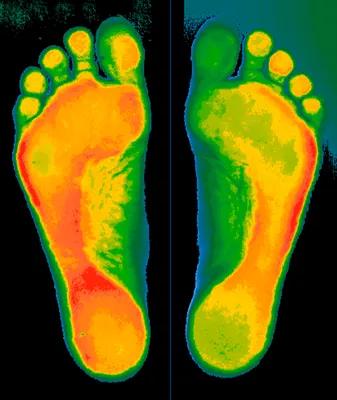 Поперечное плоскостопие в Москве | Клиника «Ваш Доктор»