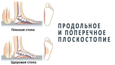 Как выбрать стельки при плоскостопии? Полезные статьи в блоге Ортека.Life