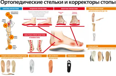 Плоскостопие - причины появления, симптомы заболевания, диагностика и  способы лечения