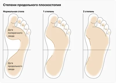 Плоскостопие: профилактика и лечени плоскостопия | Киев, Львов,  Ивано-Франковск