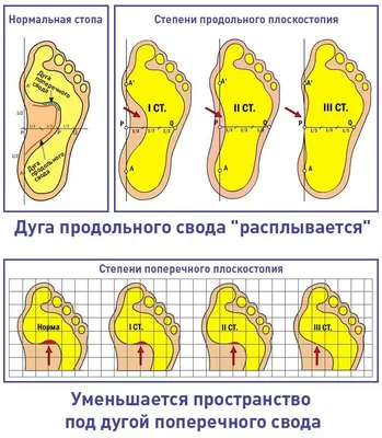 Поперечное плоскостопие или косточка на стопе - Ortoland