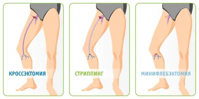 Методы лечения варикозного расширения вен | Институт здоровья