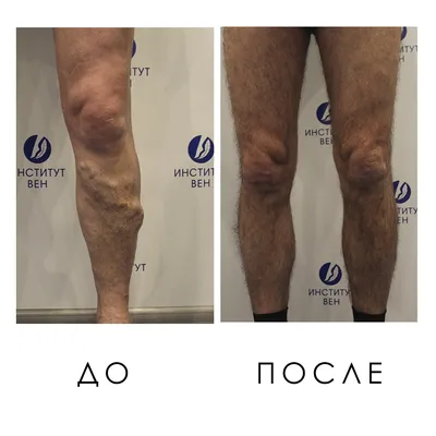 Восстановление после минифлебэктомии - «Институт Вен» лечение варикоза в  Киеве и Харькове