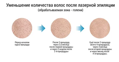 Последствия лазерной эпиляции для здоровья женщины