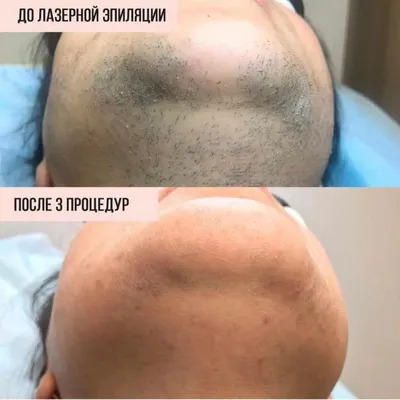 Лазерная эпиляция в Москве от 1800 руб - Jolly Clinic