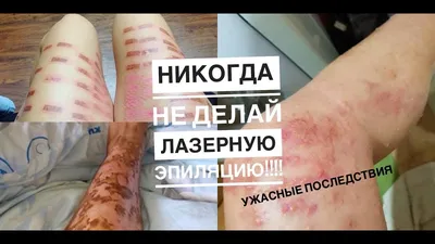 Лазерная эпиляция бикини до и после | Блог BEAUTIME