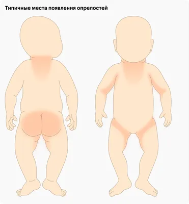 Потница у новорожденных: причины и лечение - Телеграф