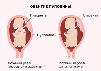 Патологическое положение плода - причины появления, симптомы заболевания,  диагностика и способы лечения