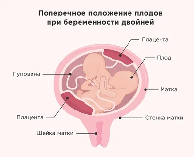 Головное предлежание плода - причины, симптомы, диагностика и лечение в  клинике «Будь Здоров»