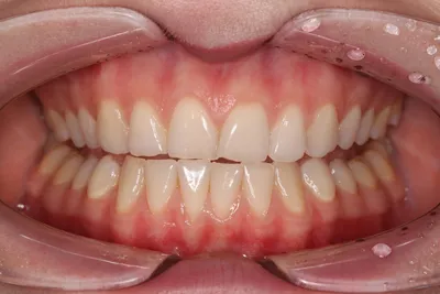 Правильный прикус у человека: фото зубов | Dental Art