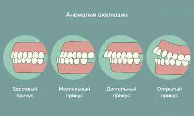 Нарушение прикуса: что такое, причины, виды