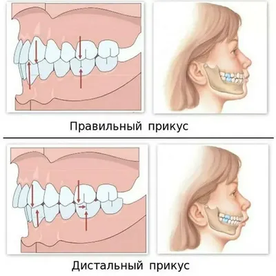 Что такое неправильный прикус? | Виды прикуса, как лечить?