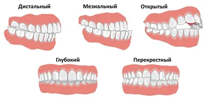 Правильный и неправильный прикус у человека