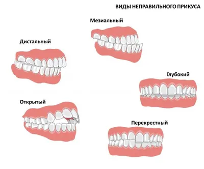 ТЕСТ: ПРАВИЛЬНЫЙ ЛИ У ВАС ПРИКУС? | Центр эстетической стоматологии | Дзен