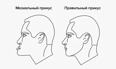 Мезиальный прикус — исправление у взрослых на Startsmile.ru