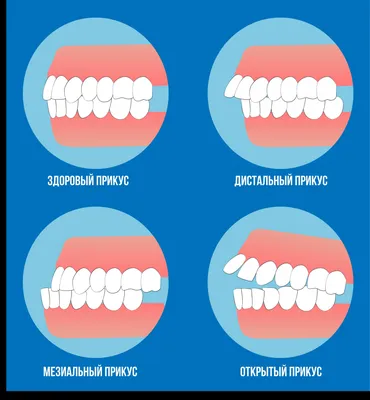 Какие виды прикуса бывают? статья пациентам «DENTAL PROGRESS»