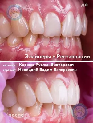 Что такое правильный прикус и почему он важен? | Dentell