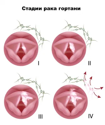 Предраковое состояние горла фото