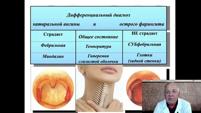 Рак горла: симптомы на ранних стадиях, признаки рака гортани: как  определить, какие анализы сдать на рак носоглотки | Клиники «Евроонко»