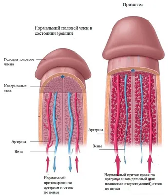 Приапизм фото