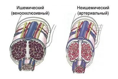 Приапизм | Университетская клиника