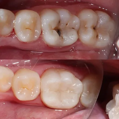 Пришеечный кариес зуба: лечение в современной стоматологии