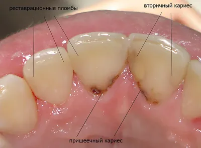 Лечение кариеса — цены в Москве | Damas Medical Center