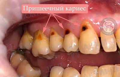 Какие виды и стадии кариеса зубов бывают, основные признаки и симптомы