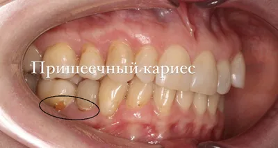 Кариес и его лечение - стоматология Мастер клиник в г.Бресте