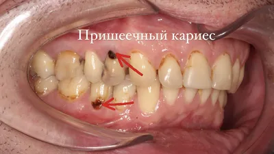 На фото пришеечный кариес. В этой зоне кариес развивается очень  стремительно, потому что слой эмали на этом участке составляет.. | ВКонтакте