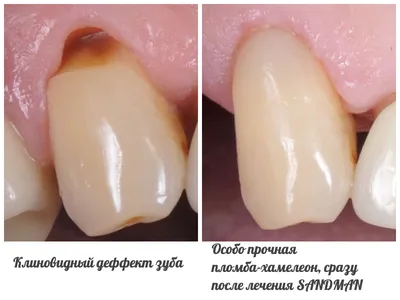 Кариес: диагностика и качественное лечение в Харькове