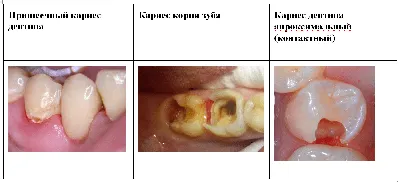 Пришеечный кариес и клиновидный дефект: два разных недуга, облюбовавшие  одну локацию | Стоматолог на всю голову | Дзен