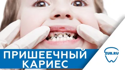 Пришеечный кариес: цена лечения в Электростали в стоматологической клинике